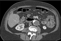 Nearly Occluded Abdominal Aorta - CTisus CT Scan