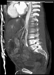 Small SMA and Celiac Lumen - CTisus CT Scan