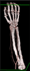 Normal CTA - CTisus CT Scan