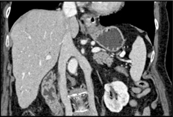 Duplicated Inferior Vena Cava (IVC) - CTisus CT Scan