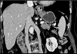 Duplicated Inferior Vena Cava (IVC) - CTisus CT Scan