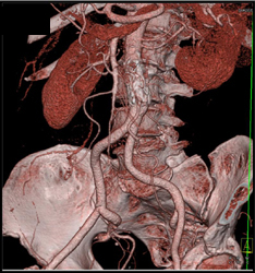 Stent in Aorta - CTisus CT Scan