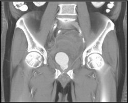 Internal Pudendal Artery Pseudoaneurysm - CTisus CT Scan