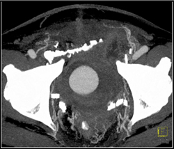 Internal Pudendal Artery Pseudoaneurysm S/P Cystoprostatectomy - CTisus CT Scan