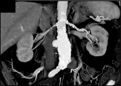 Right Renal Artery Stenosis - CTisus CT Scan