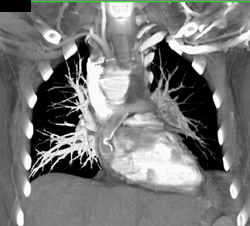 Occluded Stent Graft - CTisus CT Scan