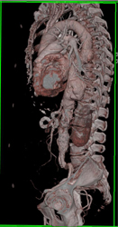 Aneurysm Descending Thoracic Aorta - CTisus CT Scan