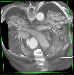 Aortic Valve W/bypass Graft - CTisus CT Scan