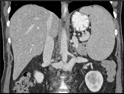 Duplication of Inferior Vena Cava (IVC) - CTisus CT Scan