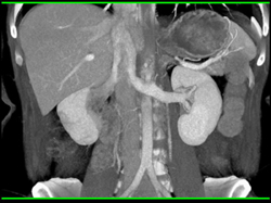 Normal Renal Veins - CTisus CT Scan