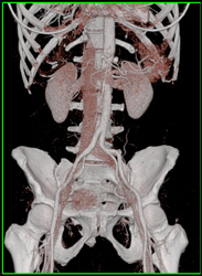 Normal CTA - CTisus CT Scan