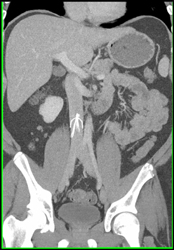 Inferior Vena Cava (IVC) Filter - CTisus CT Scan