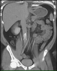 Inferior Vena Cava (IVC) Filter - CTisus CT Scan