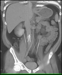 Inferior Vena Cava (IVC) Filter - CTisus CT Scan