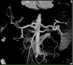 Normal Celiac Axis in VRT - CTisus CT Scan