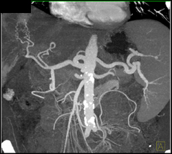 Normal Celiac Axis in MIP - CTisus CT Scan