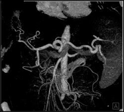 Normal Celiac Axis in VRT/MIP - CTisus CT Scan