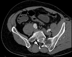 Aortic Dissection - CTisus CT Scan