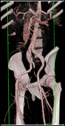 Aortic Dissection - CTisus CT Scan