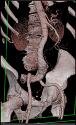 Aortic Dissection - CTisus CT Scan