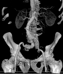 Iliac Aa Aneurysms - CTisus CT Scan