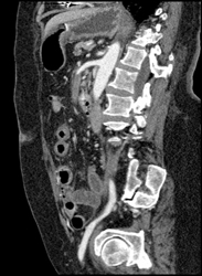 Clot in SMA With Ischemic Bowel - CTisus CT Scan