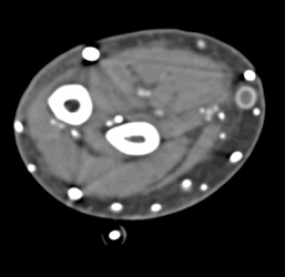 Clotted Dialysis Catheter - Vascular Case Studies - CTisus CT Scanning