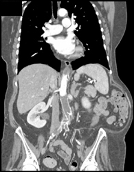 Occluded Graft From Aorta to Iliac Aa - CTisus CT Scan