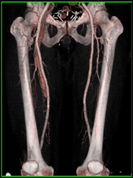 Arteriovenous (AV) Fistulae in Right Mid Thigh - CTisus CT Scan