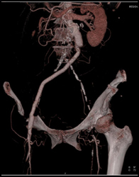 Occluded Left Limb of Aortoiliac Grafts - CTisus CT Scan