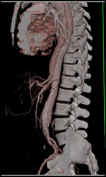 Aortic Dissection - CTisus CT Scan