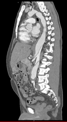 Aortic Dissection - CTisus CT Scan