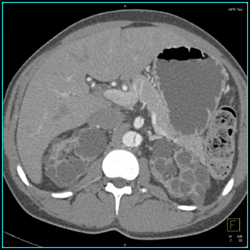 Aortic Dissection Extends Into SMA - CTisus CT Scan