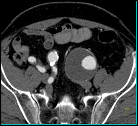 Aortic Aneurysm Extends Into the Left Iliac Aa - CTisus CT Scan