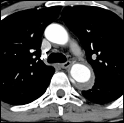 Ulceration With Intramural Hematoma - CTisus CT Scan