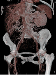 Fem-fem Grafts - CTisus CT Scan