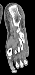 Cellulitis W/o Vasculitis - CTisus CT Scan