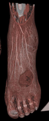 Ulceration - CTisus CT Scan