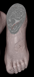 Ulceration With Low Flow - CTisus CT Scan