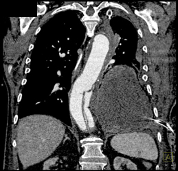 Aortic Dissection - CTisus CT Scan