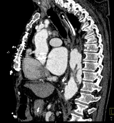 Aortic Dissection - CTisus CT Scan