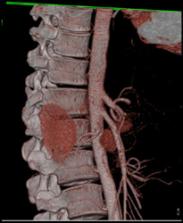 Occlusion of Celiac Aa - CTisus CT Scan