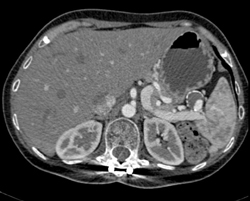 Splenic Aa Aneurysm - CTisus CT Scan