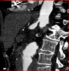 Stenosis of Origin of Celiac Aa - CTisus CT Scan