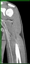 Normal CTA Axilla - CTisus CT Scan