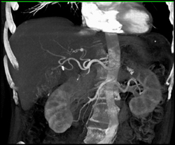 5 Mm Hepatic Artery Aneurysm - CTisus CT Scan