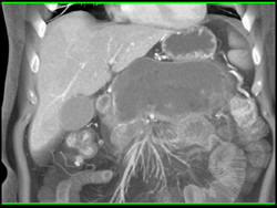 Splenic Vein Occlusion Due to Pancreatitis - CTisus CT Scan