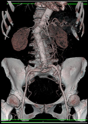 Prior Aortic Aneurysm Repair - CTisus CT Scan