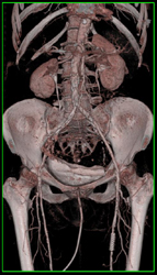 Atherosclerotic Disease Iliac Artery and Superficial Femoral Arteries (SFAs) - CTisus CT Scan