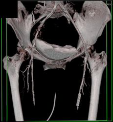 Stent in Left Superficial Femoral Artery (SFA) - CTisus CT Scan